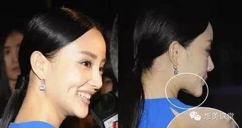 明星假体下巴,美丽背后的秘密与风险